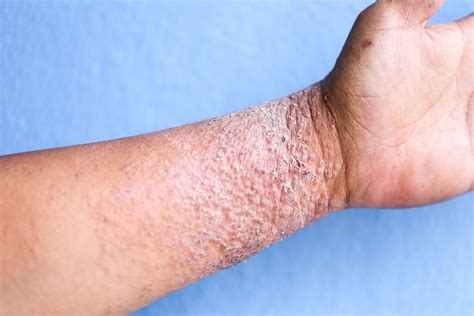 eczema pele-1